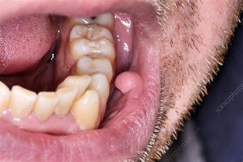 Avoid brushing the sore for this reason, using a mouthrinse to ensure your soft tissue remains healthy without the added irritation. . Pictures of irritated oral fibroma